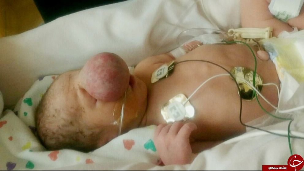 بیماری عجیب یک کودک پزشکان را به چالش کشید+تصاویر