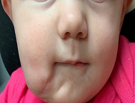 تولد نوزاد با دو دهان+تصویر