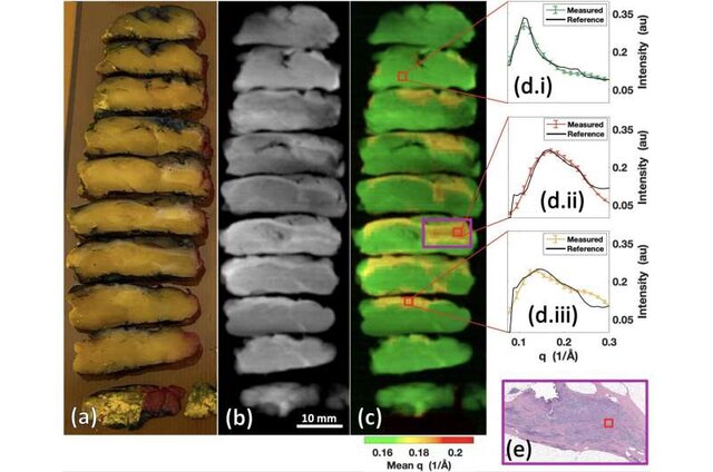 تشخیص سرطان در چند دقیقه با کمک اشعه ایکس