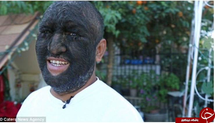 «مرد گرگی» که ۹۸ درصد بدنش را مو پوشانده است+ تصاویر