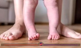کمبود کدام ویتامین باعث ابتلا به پای پرانتزی می‌شود؟