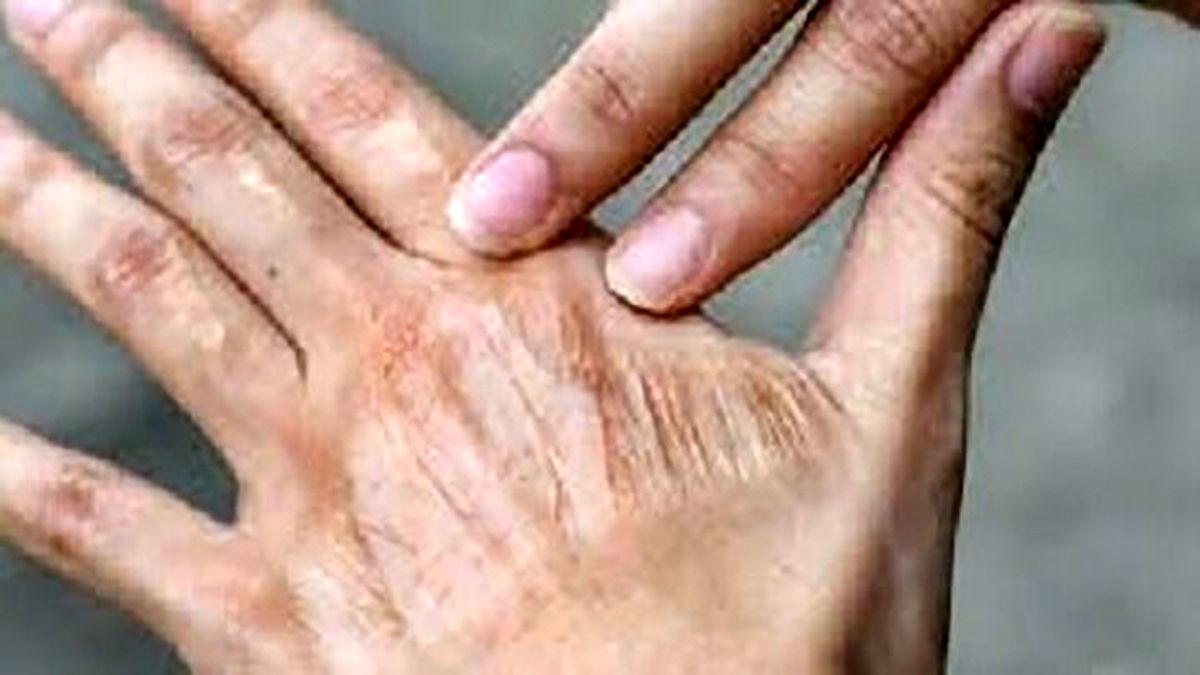اقدام ساده برای رفع خشکی پوست