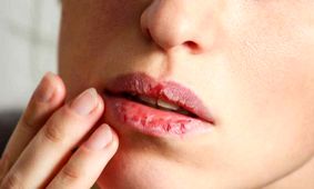 با ترک لب چه کنیم؟

