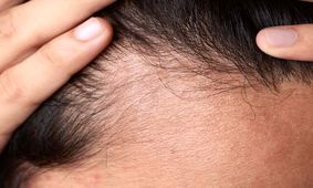 دلایل ریزش مو چیست؟