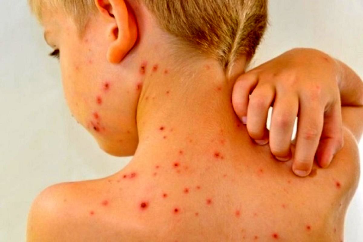 مهمترین علامت ابتلا به سرخک