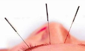 طب سوزنی در کاهش وزن موثر است​