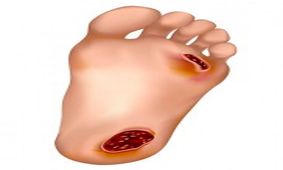زخم پا در دیابتی ها جدی است/ نقش طب فیزیکی و توانبخشی