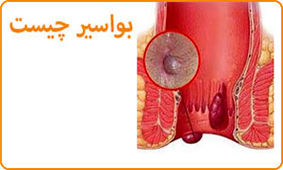  مهمترین عادات و علل ابتلا به بواسیر کدامند ؟