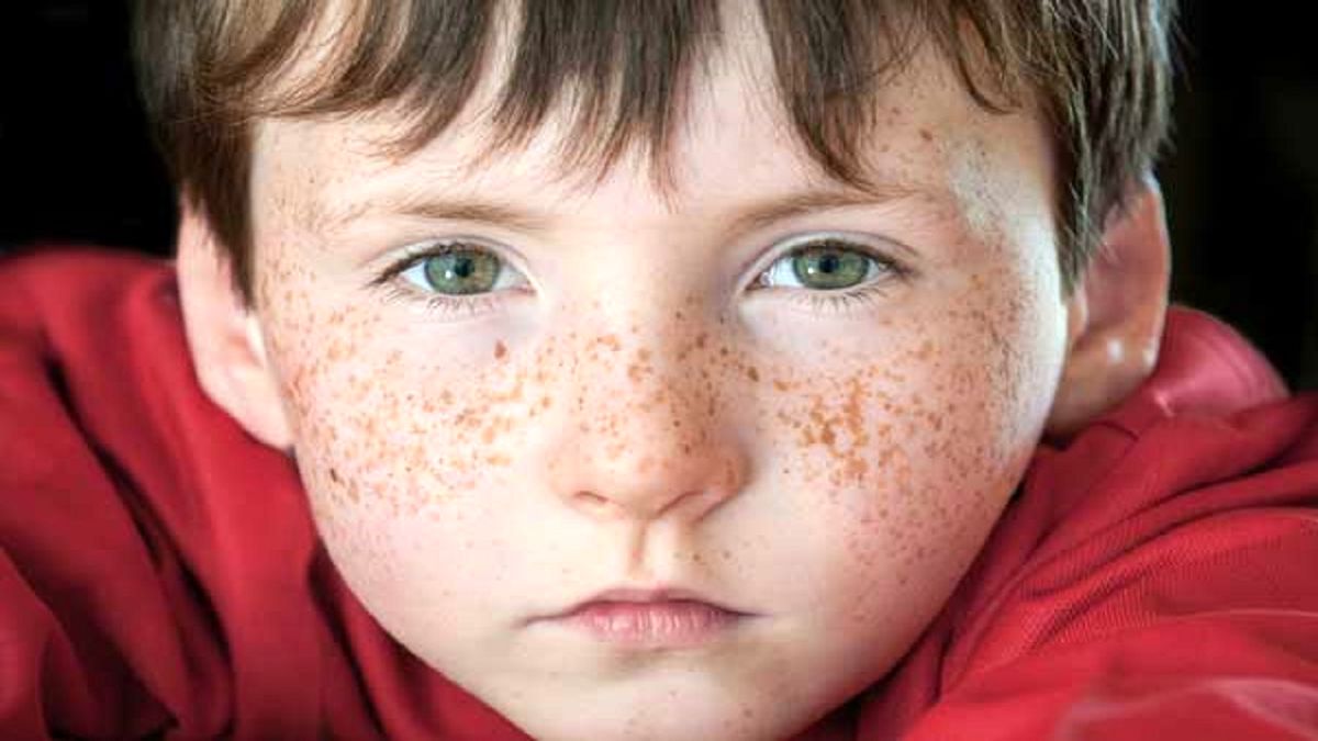 علت به وجود آمدن کک و مک صورت و راه‌های درمان آن
