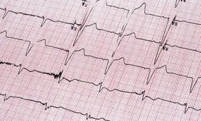 استفاده از روشی نوین در کنترل آریتمی‌های بطنی در بیمارستان امام اهواز