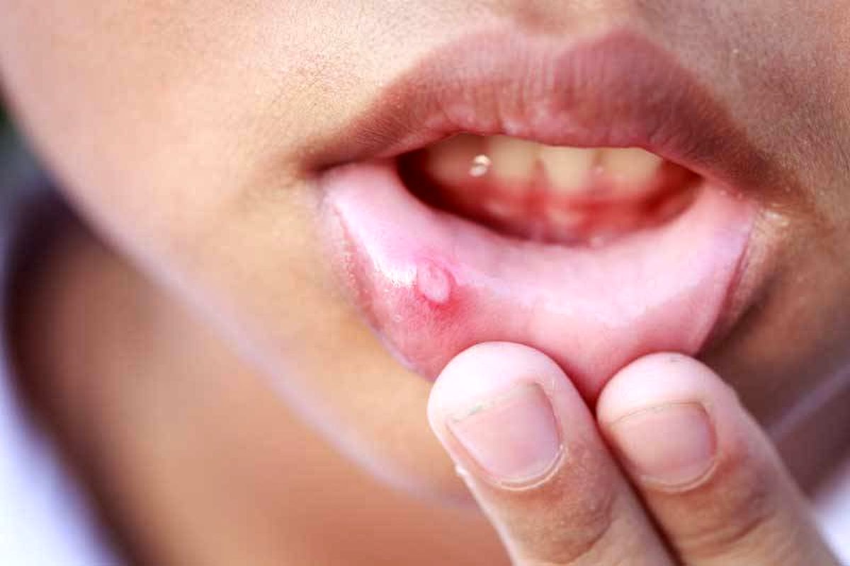 ارتباط سلامت روان و آفت دهان