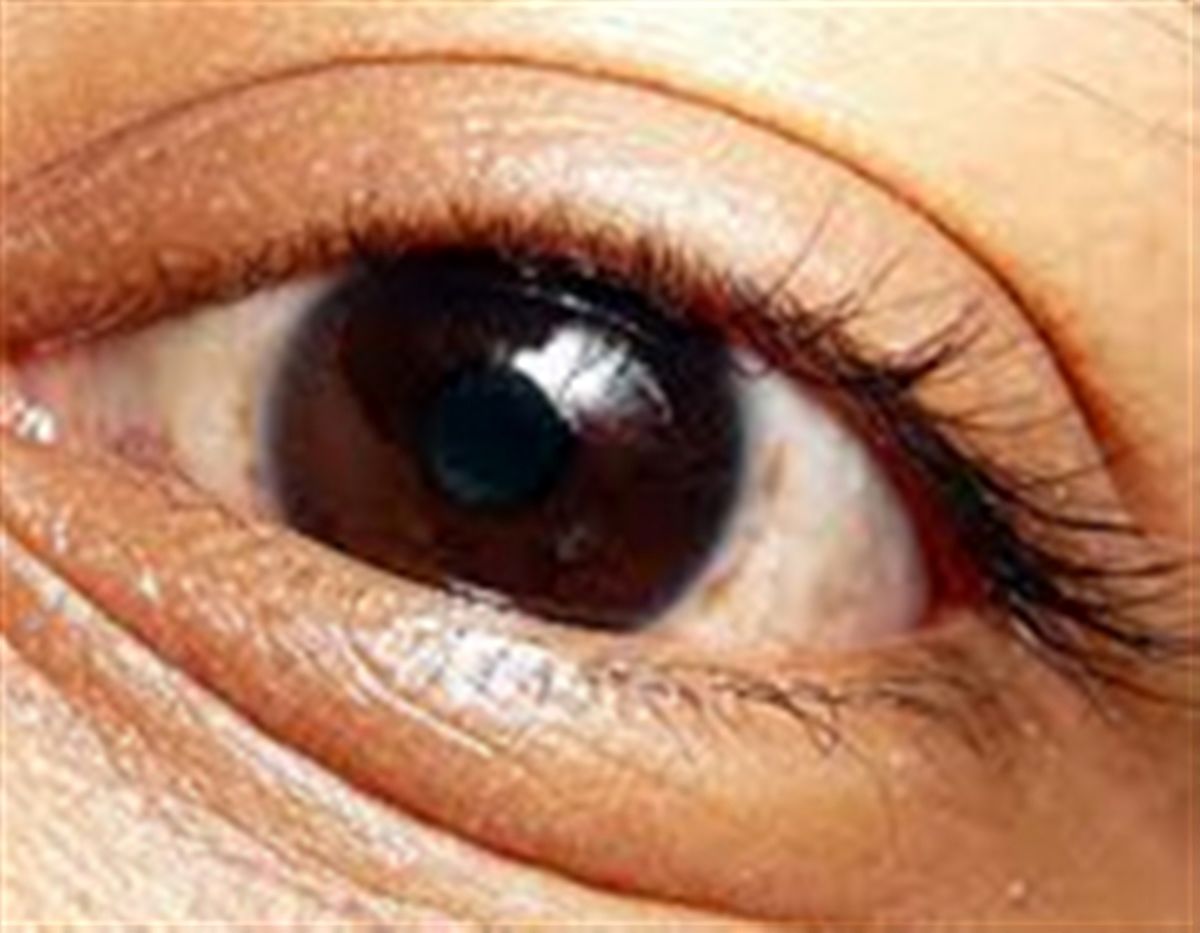 عوامل تولیدکننده کیسه‌های زیر چشم و روش‌های کاهش آن
