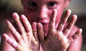 محموله پانسمان های بیماران پروانه ای در انبارهای وزارت بهداشت است/مفقودی پانسمانها صحت ندارد