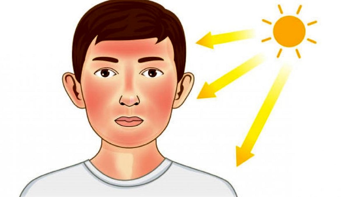 کار‌هایی که پس از ابتلا به آفتاب سوختگی نباید انجام داد