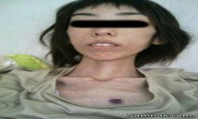 دختر جوانی که براثر شکنجه 16 کیلو شد!