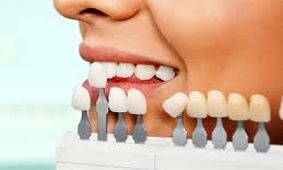 لمینت دندان چیست و چه تفاوتی با ایمپلنت دارد؟