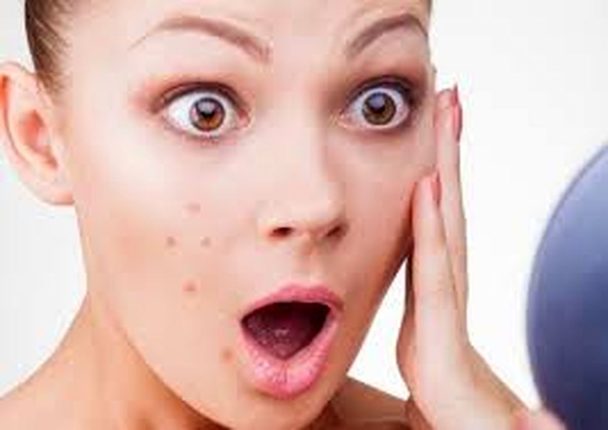 ماسک صورت جوش را بدتر می کند / قلیان در جوش زدن تاثیر دارد؟