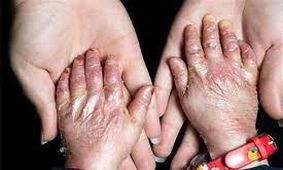 تحریم ‎های آمریکا و کارشکنی ‎های سوئد مانع دسترسی کودکان‌ «ای‌بی» به پانسمان‌